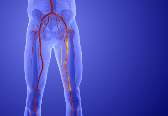 Animation of peripheral artery bypass surgery 3d illustration.