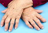 Arthritic hands