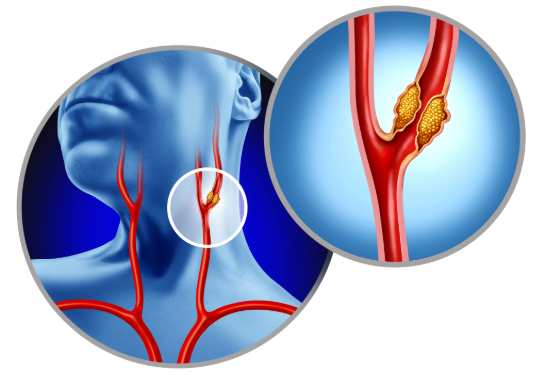 Illustration of carotid artery that shows plaque buildup inside the blocked vessel causing narrowing or stenosis.