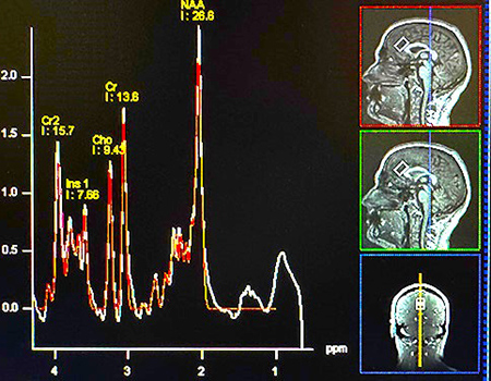 A graphic showing a chart with multiple peaks against a black background and three small MRI brain images on the right. 
