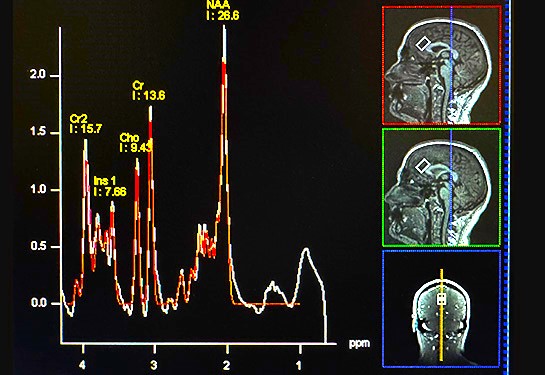 A graphic showing a chart with multiple peaks against a black background and three small MRI brain images on the right. 