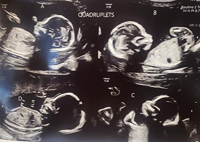 ultrasound of 4 babies