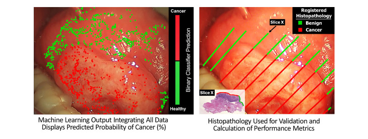 two photos showing FLIm&rsquo;s prediction of cancer tissues (highlighted in red) and benign tissues (in green)