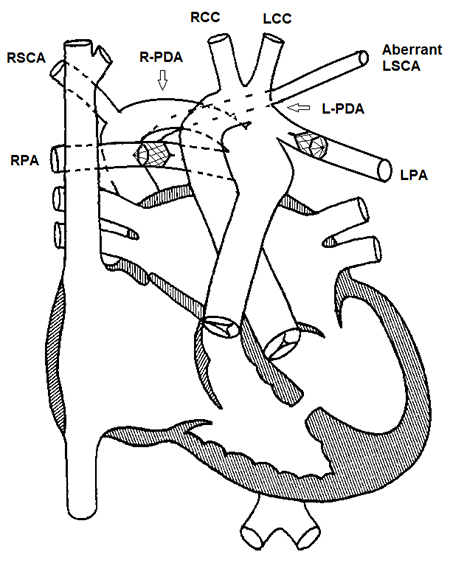 A medical illustration of Lillian's heart anatomy