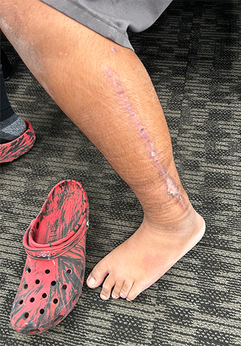 Large scar on outside of calf with red and black shoe next to person&rsquo;s foot. 