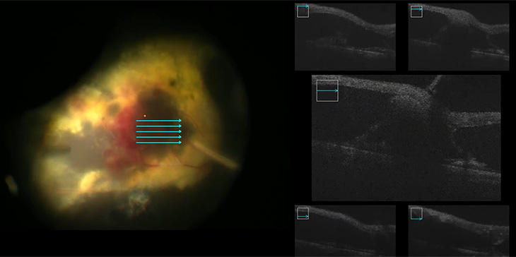 macular edema