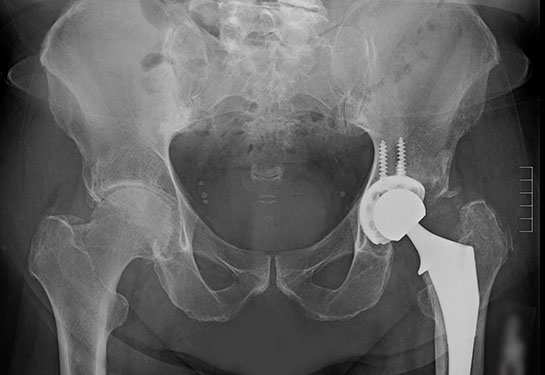 An Xray of a man getting a hip replacement