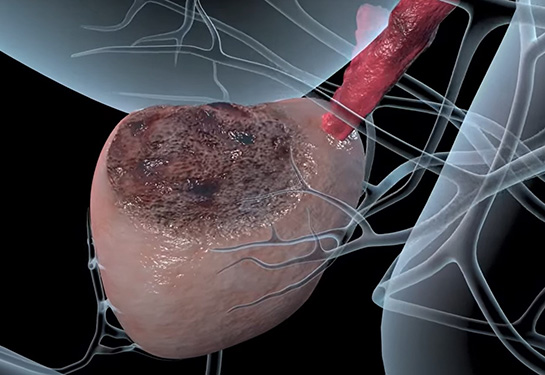 3D medical illustration of prostate cancer
