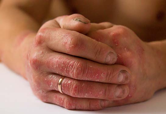 Two hands with psoriasis