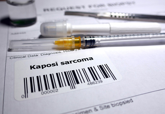 Request for biopsy Kaposi's sarcoma