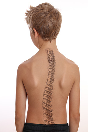 A child&rsquo;s back with scoliosis