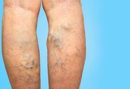 Varicose veins on female legs.