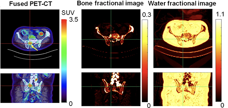 Three rows of colorful image pairs grouped by headings: &ldquo;Fused PET-CT&rdquo;, &ldquo;Bone fractional image&rdquo; and &ldquo;Water fractional image.&rdquo;
